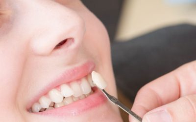 Cosa sono le faccette dentali?