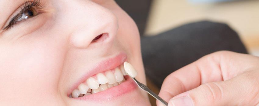 Cosa sono le faccette dentali?